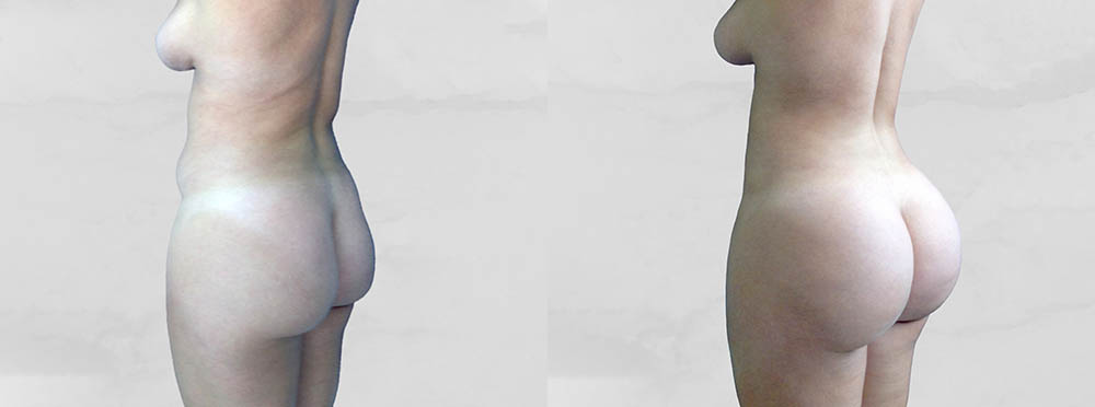 BBL Before and After