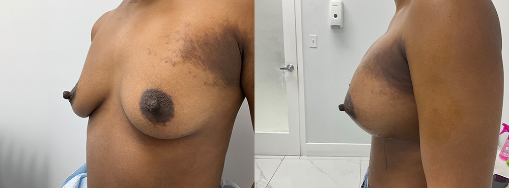 Breast Augmentation Before and After