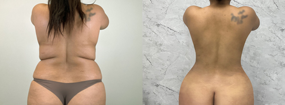 Lipo 360 Before and After