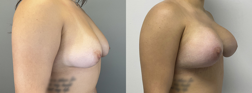 Breast Lift Before and After