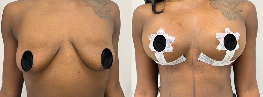 Breast lift before and after in miami