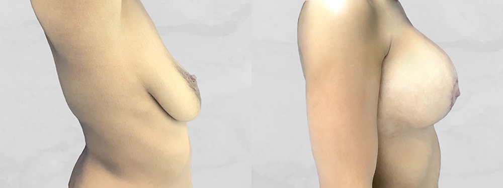 Breast Augmentation