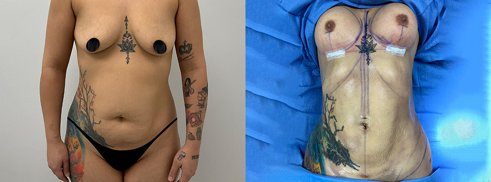 Mommy Makeover Before and After