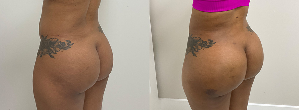 Brazilian Butt Lift Before and After