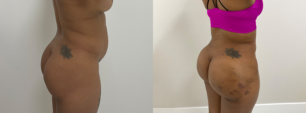 Brazilian Butt Lift Before and After
