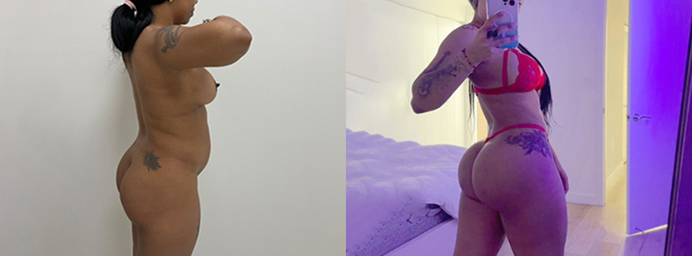 Brazilian Butt Lift Before and After
