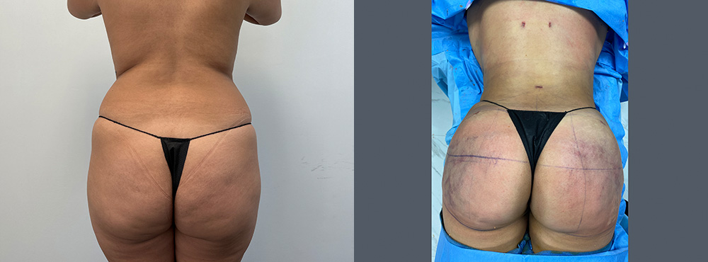 Brazilian Butt Lift before and after 