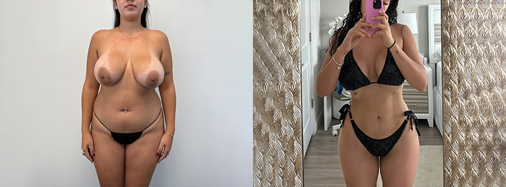 Brazilian Butt Lift before and after 