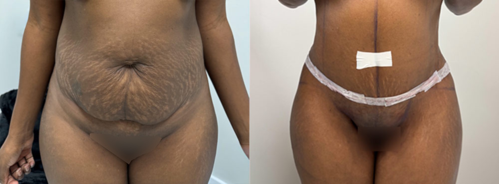 Tummy Tuck Before and After