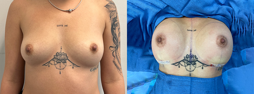 Breast Augmentation Before and After