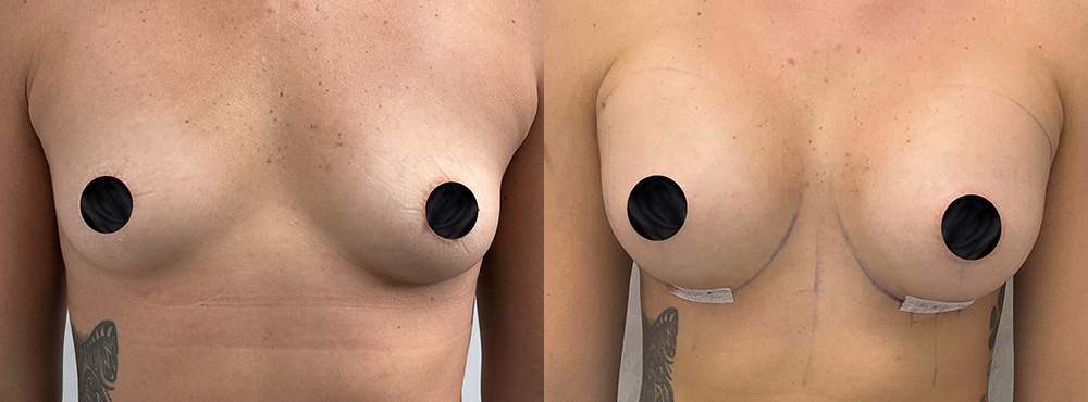 Breast Augmentation before and after in miami