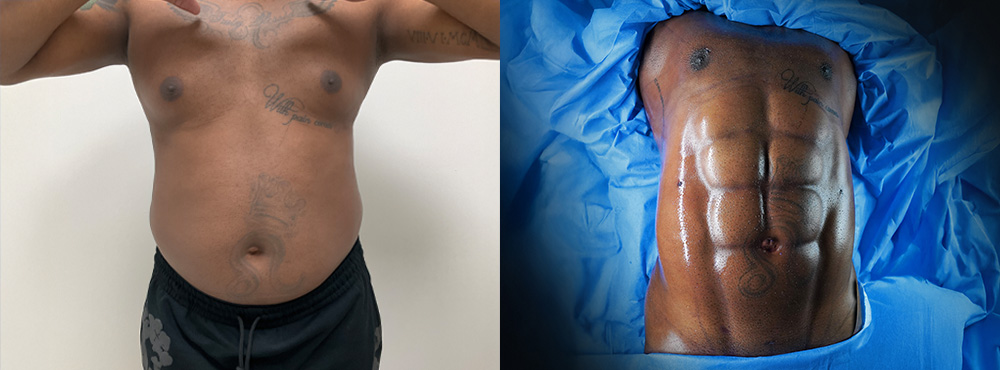ab etching before and after in miami