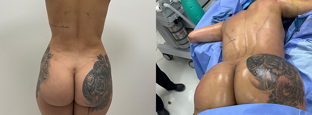 Brazilian Butt Lift before and after