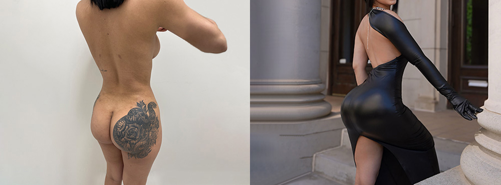 Brazilian Butt Lift before and after