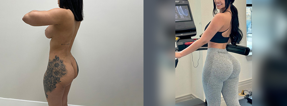 Brazilian Butt Lift before and after