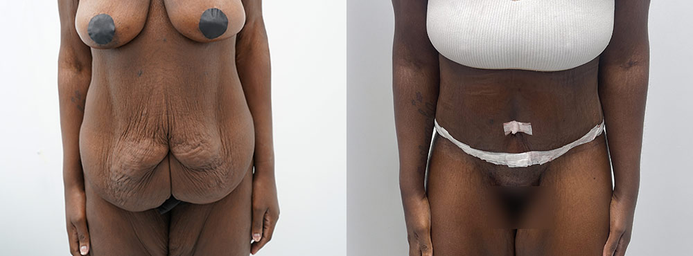 Tummy Tuck Before and After