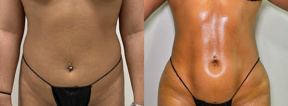 Abdominal Etching Before and After