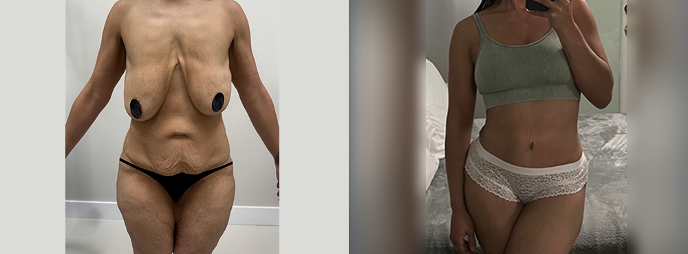 Mommy Makeover Before and After