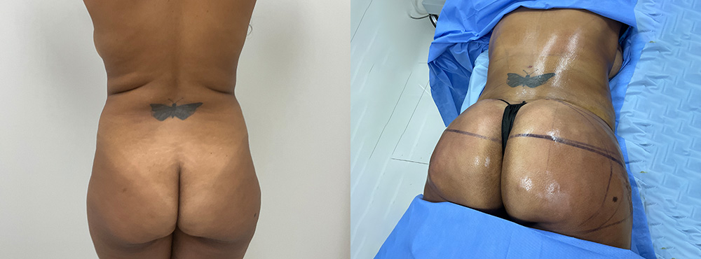 Breast Lift Before and After in Miami