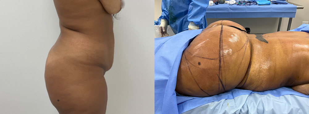 Breast Lift Before and After in Miami
