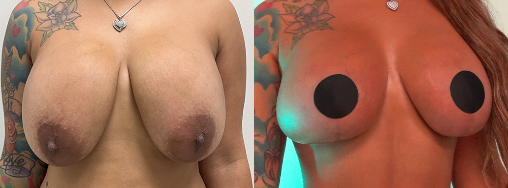 Breast Lift Before and After