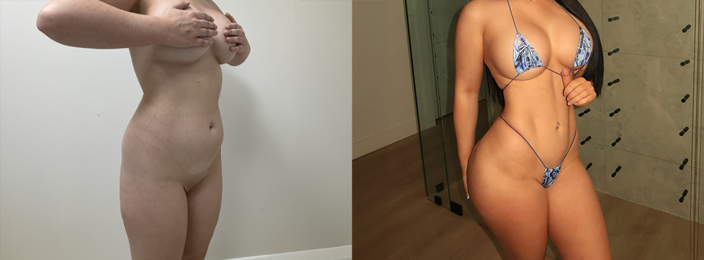 BBL before and after in miami
