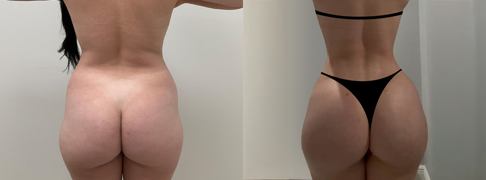 butt lift before and after