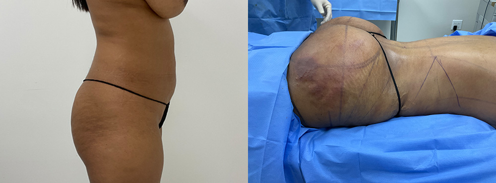 Mommy Makeover Before and After