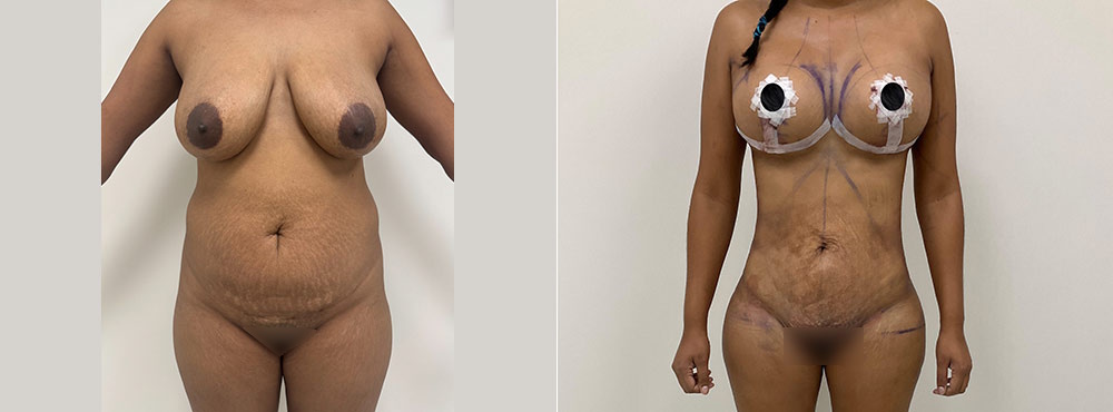 Mommy Makeover Before and After