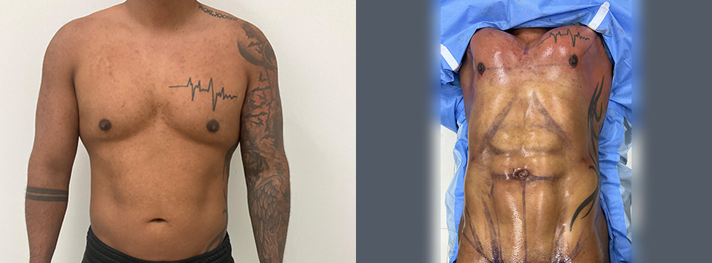 Abdominal Etching Before and After