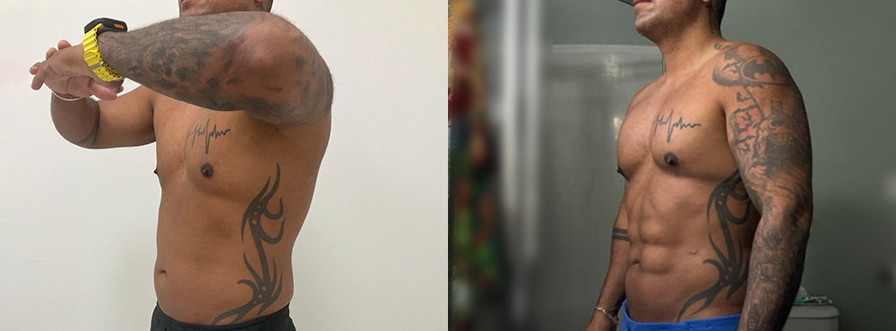 Abdominal Etching Before and After