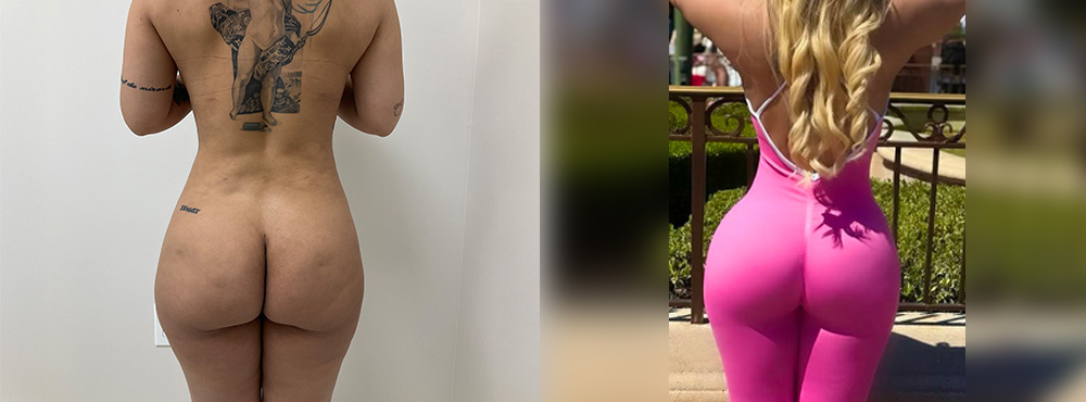 Lipo 360 before and after