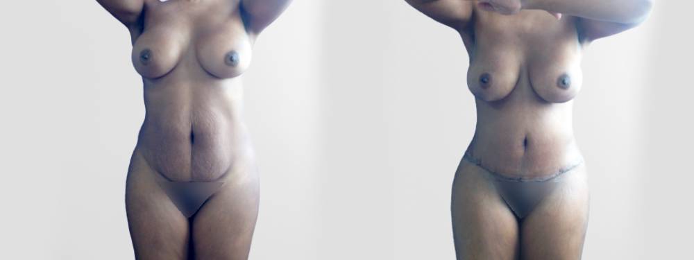 Tummy Tuck