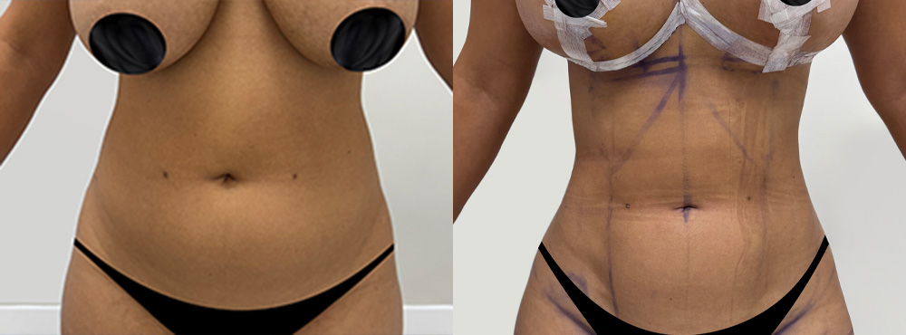 Lipo 360 before and after