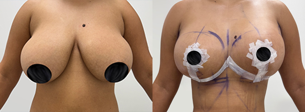 Breast Lift Before and after