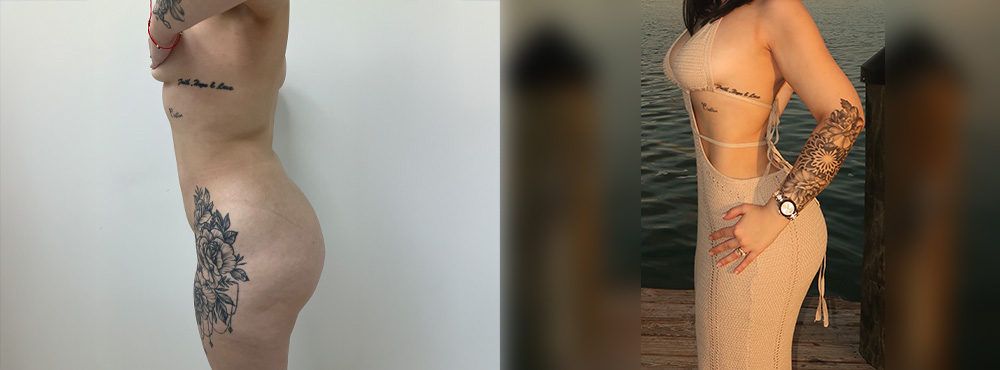 BBL before and after