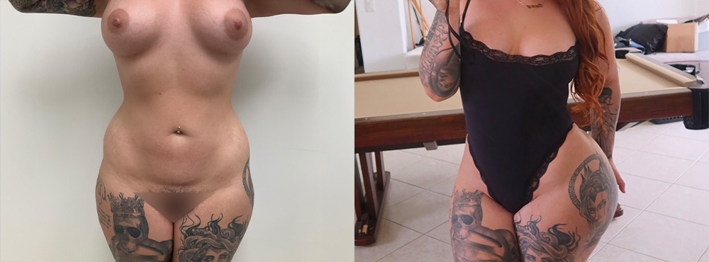 BBL Before and After in miami
