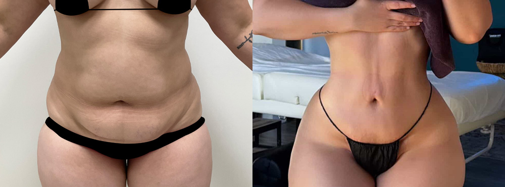 Lipo 360 Before and After