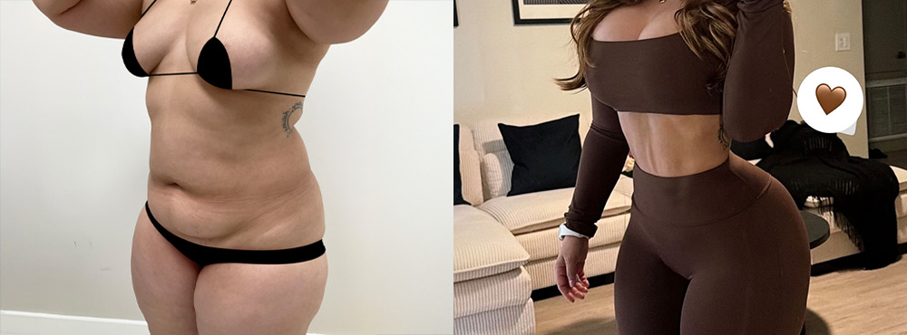 Lipo 360 Before and After