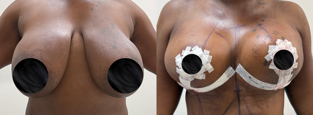 Breast Reduction Before and After