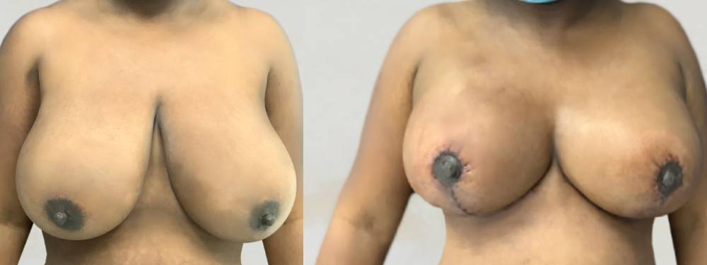 Breast Lift