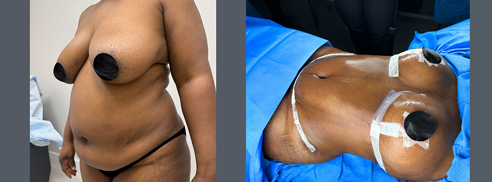 Mommy Makeover Before and After