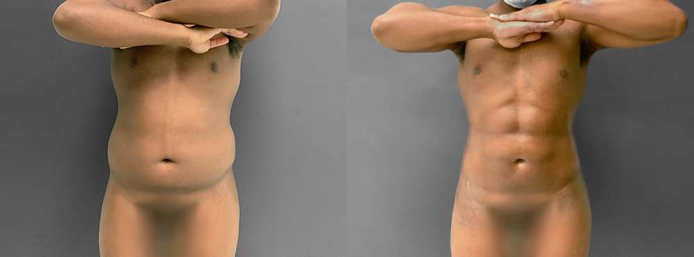 Abdominal Etching Before and After
