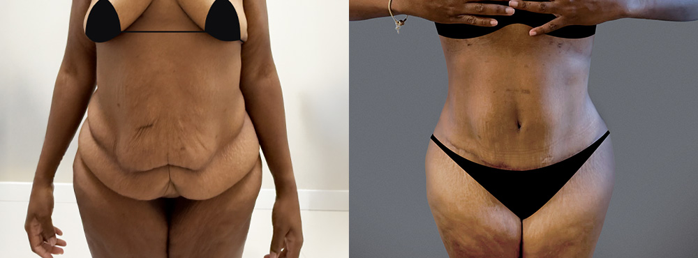 TT Before and After in Miami