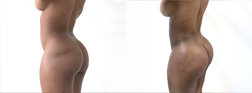 BBL Before and After