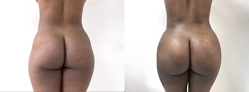 BBL Before and After