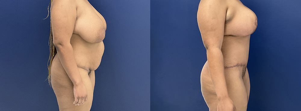 Mommy Makeover Before and After