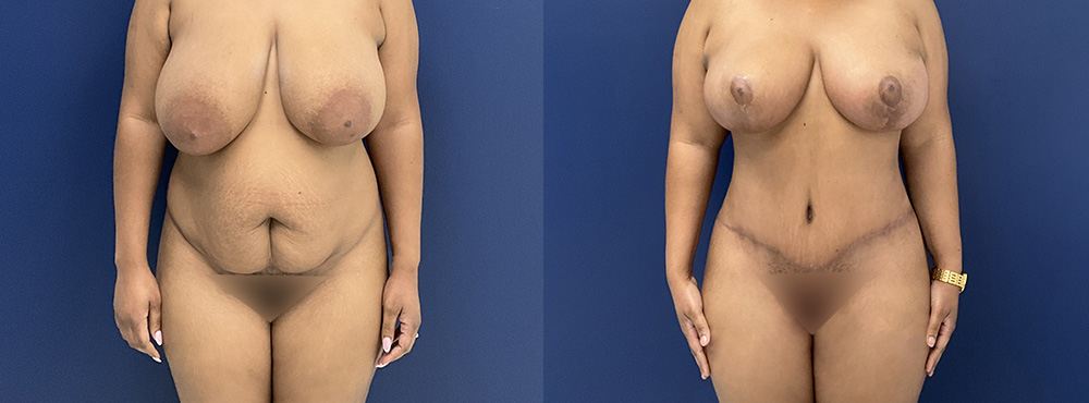 Mommy Makeover Before and After