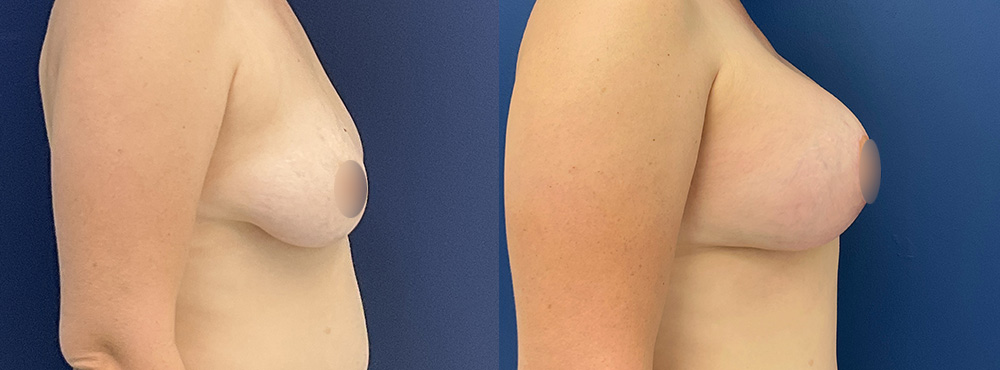 Breast Lift  Before and After