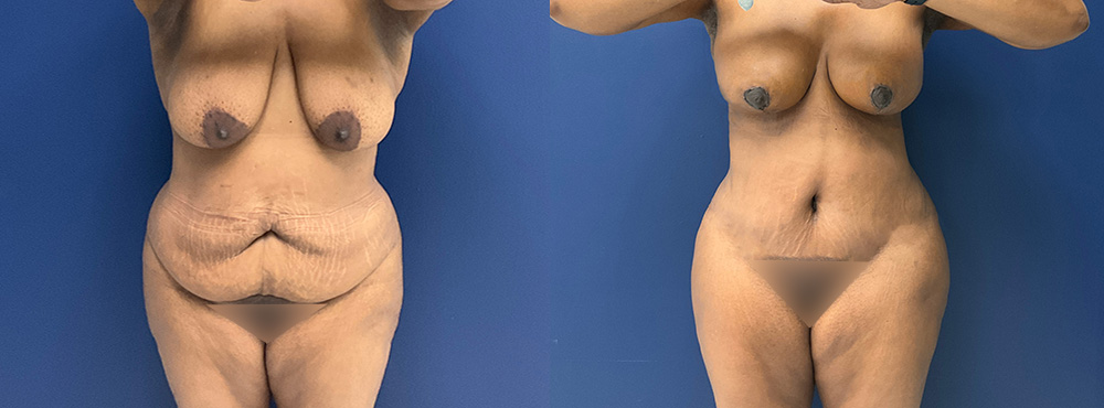 Mommy Makeover Before and After